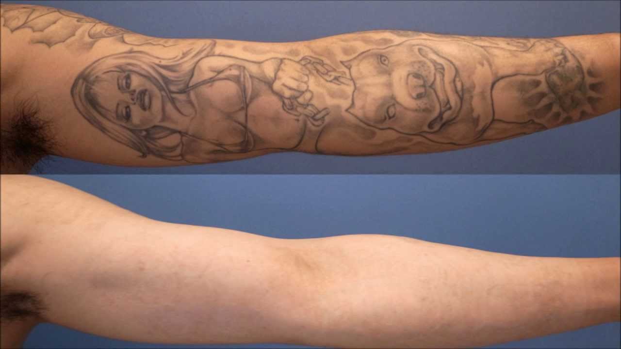 タトゥー除去レーザー経過報告1年9ヵ月 laser tattoo removal interim report タトゥー除去レーザー経過報告1年9ヵ月 laser tattoo removal interim report