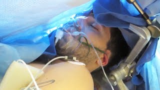 AWAKE BRAIN SURGERY (Uncensored - Resection of Oligodendroglioma, Right Frontal Lobe)