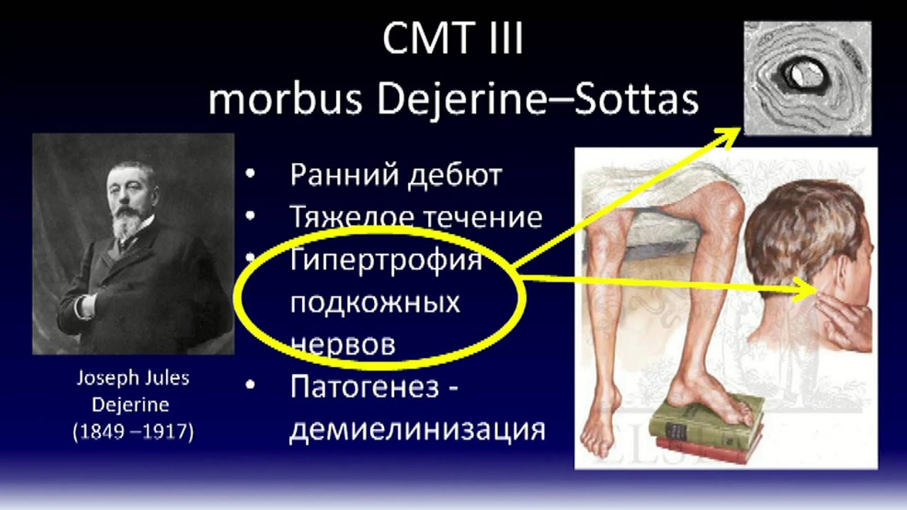 Болезнь шарко мари тута презентация