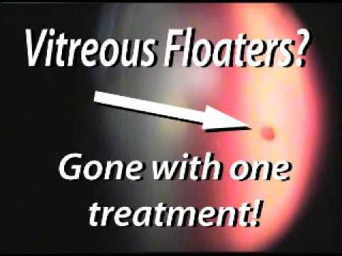 Treatment Of Eye Floaters