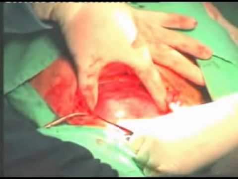 Seorang ibu melahirkan anak - YouTube