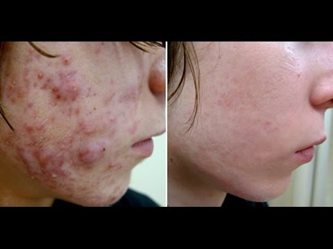 Corticosteroid injection for acne cyst