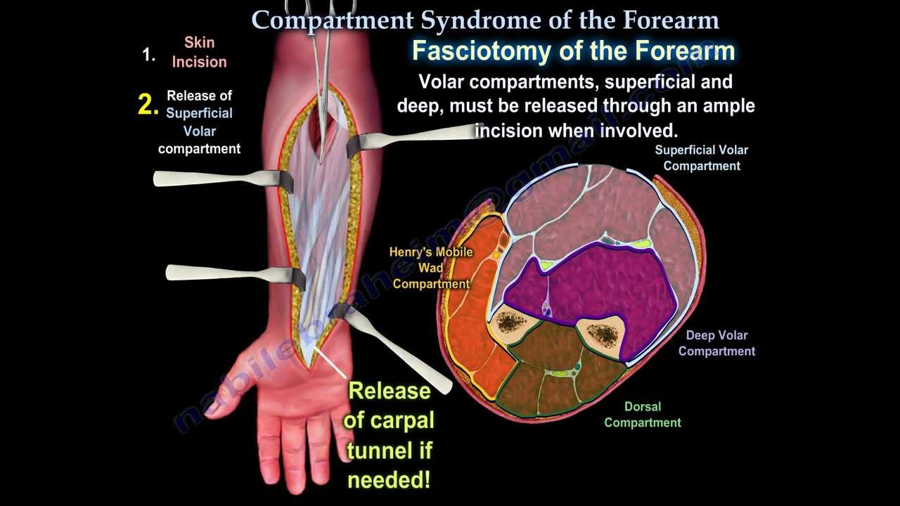 Compartment Syndrome Of The Forearm - Everything You Need To Know - Dr