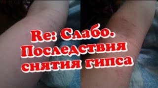 Re: Слабо. Последствия снятия гипса