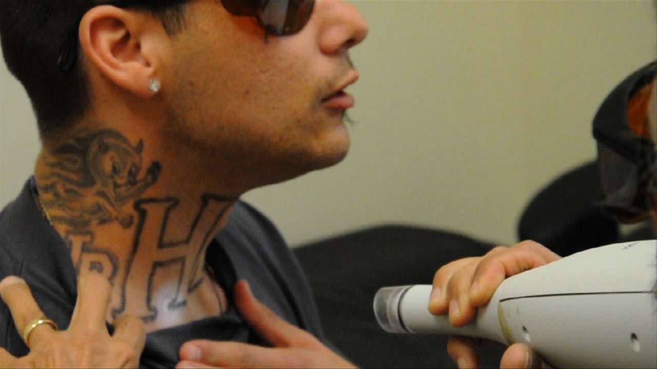 Gang Tattoo Removal Programs