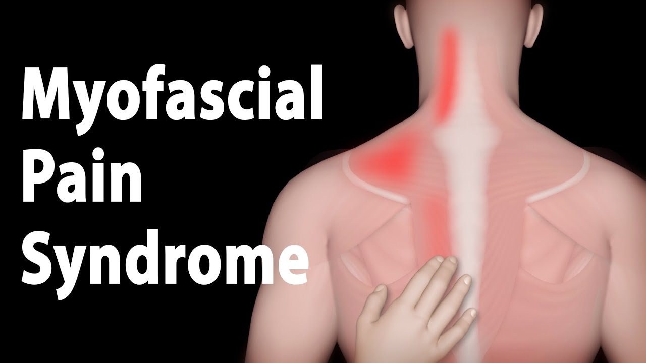 Myofascial Pain Syndrome and Trigger Points Treatments, Animation