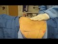 Video: SmartLipo-Abdomen-Flanks-Laser Lipo-Valley Aesthetics and Laser