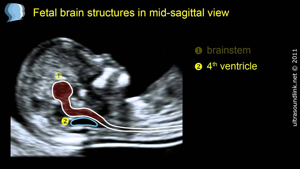 Normal fetal brain anatomy at 11-13 weeks - 2D scan - YouTube