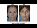 Video: Plastic Surgery - face lift - neck lift