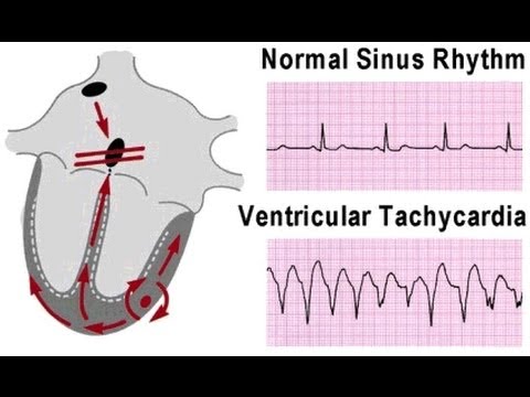 ventricular tachycardia heart vt surgery fibrillation valve atrial rhythm arrhythmias symptoms tach normal sinus causes heartbeat vtac cardiac arrhythmia treatment