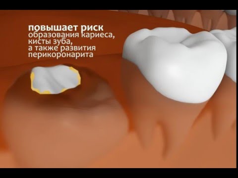 Прорезывание зуба мудрости - YouTube