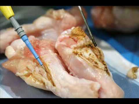 Laser vs Cautery Labiaplasty - YouTube