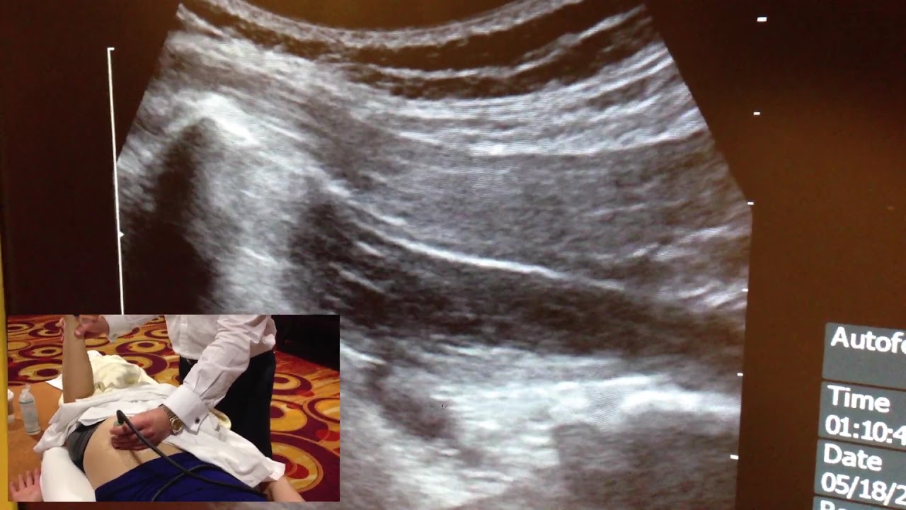 Ultrasound Image Of The Piriformis Muscle The Pm Piri - Vrogue.co