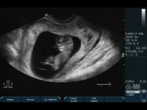 11 week ultrasound - YouTube