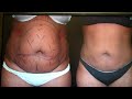 Video: Smartlipo of Abdomen