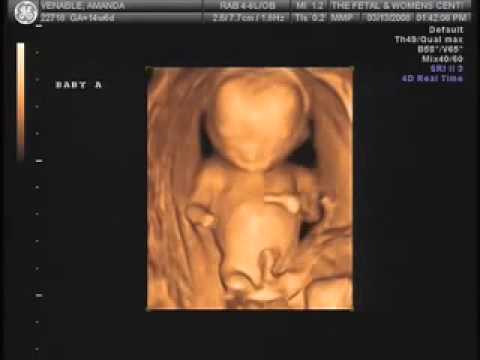 Twins 4d Ultrasound 14 Weeks 6 Days old, Boy and Girl ...