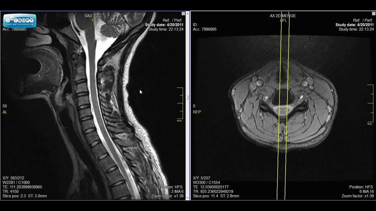 Normal Cervical Spine MRI Explained | Dr. Jeffrey P.Johnson | HD - YouTube