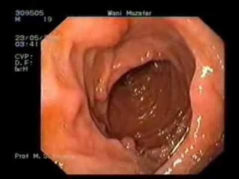 Removal of multiple stomach tumors - YouTube