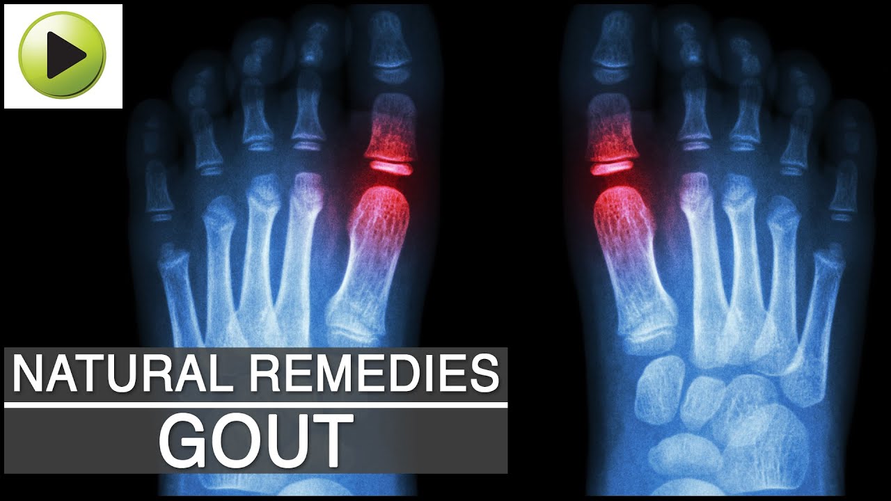 Aches amp; Pains  Gout  Natural Ayurvedic Home Remedies  YouTube