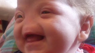 Inspirational: Baby Born With No Nose