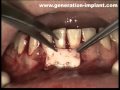 Implants Dentaires : Greffe gingivale libre