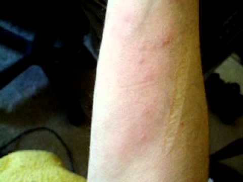 Bed Bugs/Scabies/Flea Bites? - YouTube