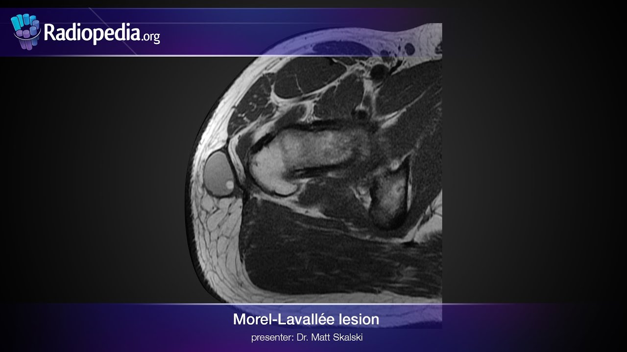 MorelLavallée lesion radiology video tutorial (MRI, ultrasound