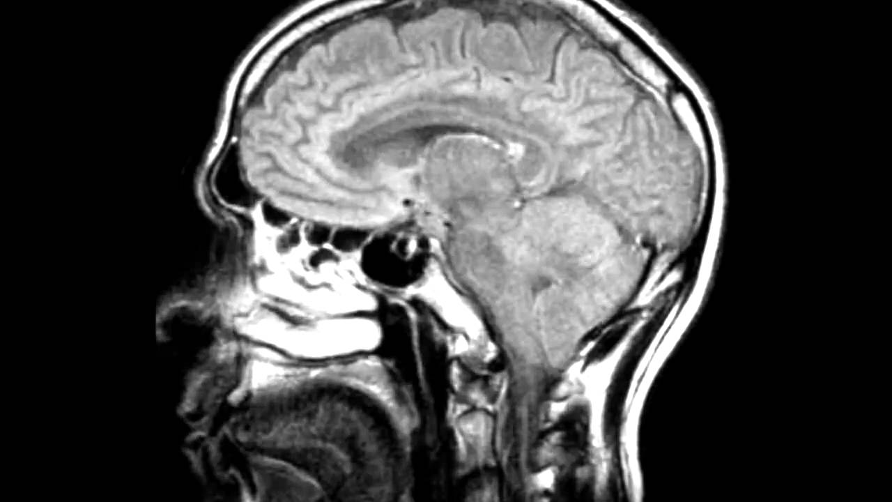 Brain MRI - Multiple Sclerosis - YouTube
