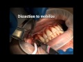 How to Correct Gingival Recession with Perioderm (and save your patient's palate)