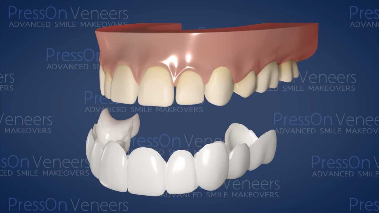teeth veneers press