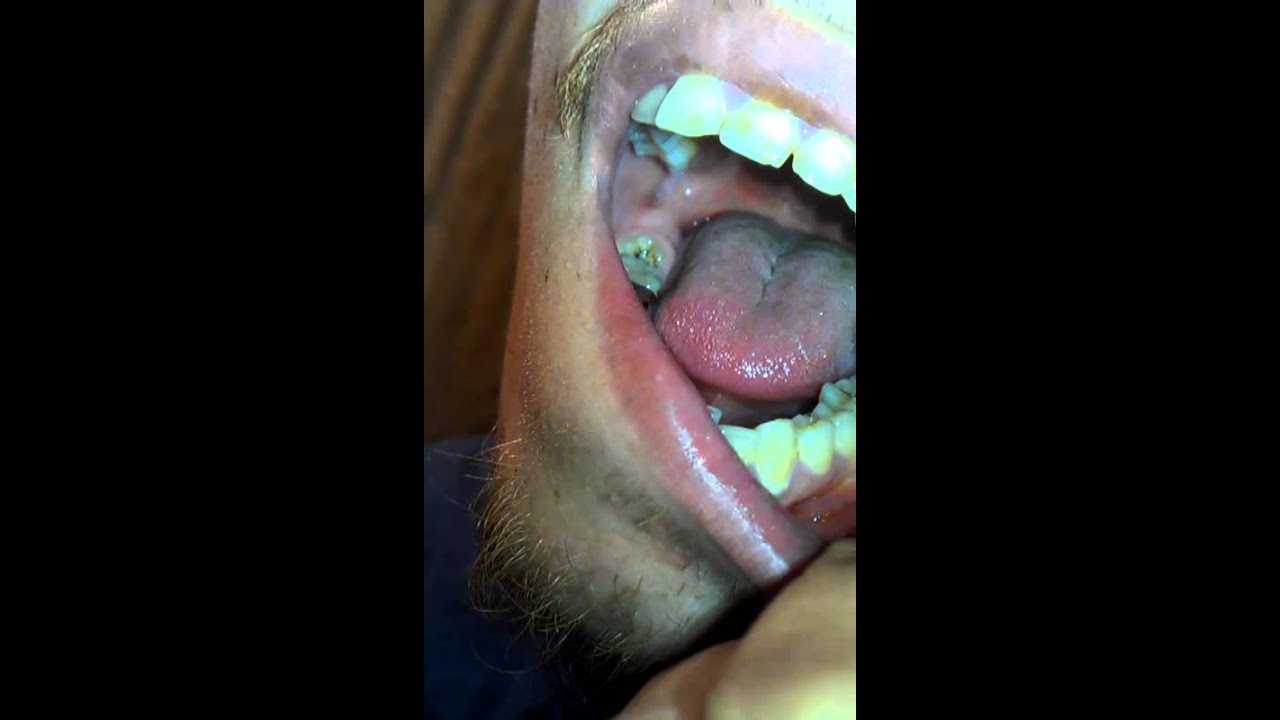 Abcess In Mouth 51
