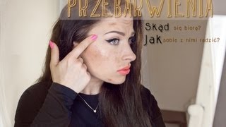 ** Przebarwienia - skąd, jakie, czym? **