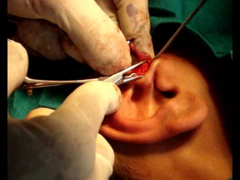 Excision of Preauricular Sinus - YouTube