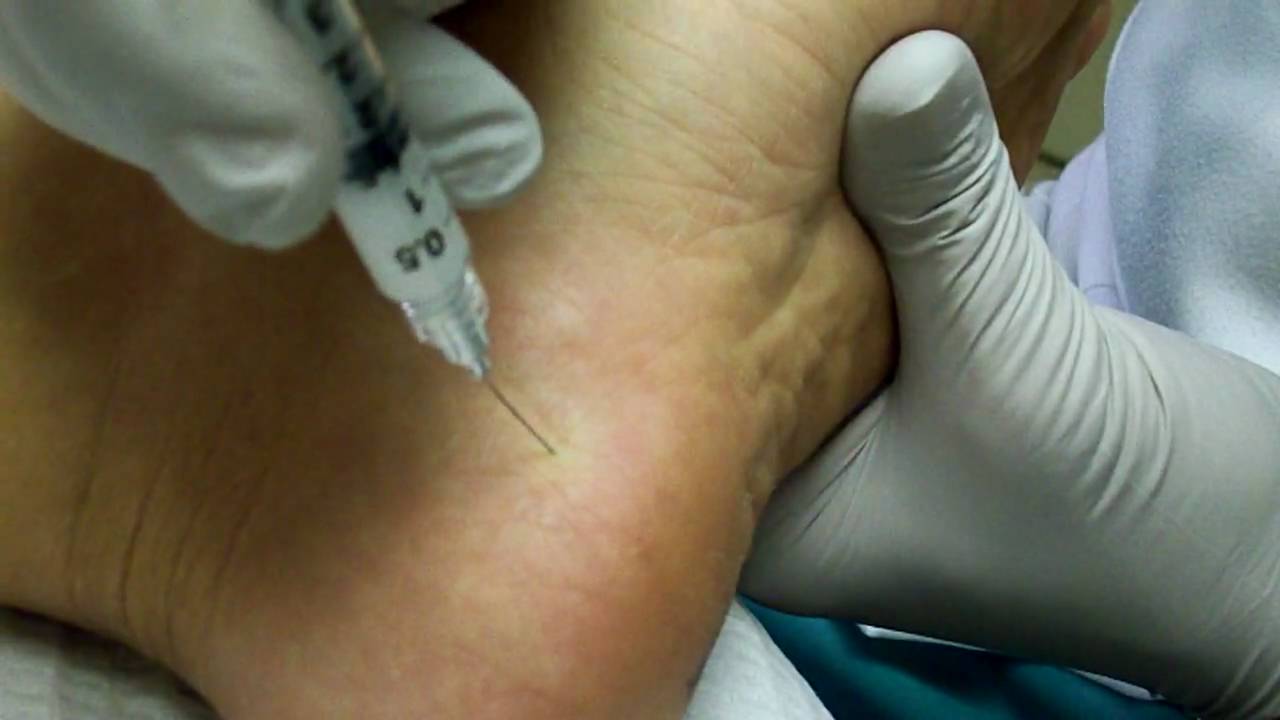 Heel spur or plantar fascia injection - YouTube