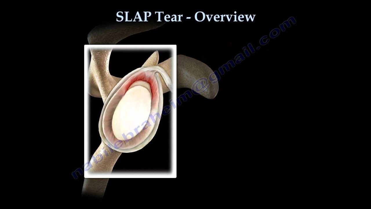 SLAP Tear Overview - Everything You Need To Know - Dr. Nabil Ebraheim