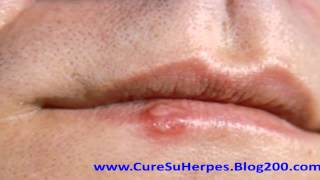 Remedios caseros para el herpes labial