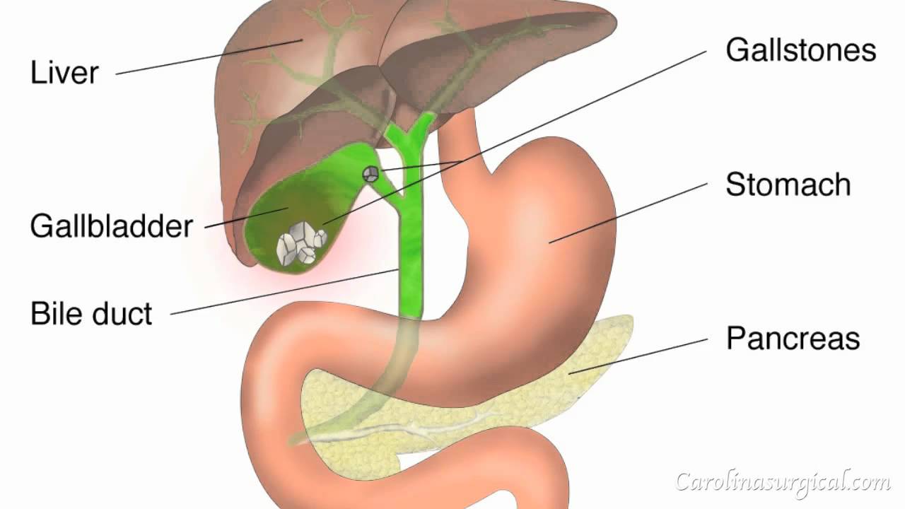 Gallbladder Removal Surgery Animation - YouTube