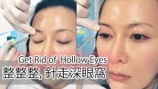 ♛[QQ又整容]我要打腫佢!♥Fixing Hollow Eyes