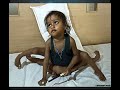 8 limbed baby to have an operation