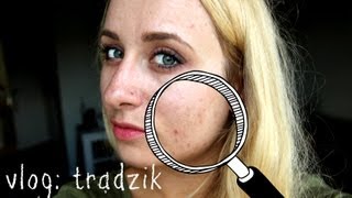 VLOG: TRĄDZIK, NOWA KURACJA