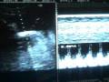 EMBARAZO 38.6 SEMANAS-SONOGRAM PREGNANCY 38.6 WEEKS - IT´S A BOY