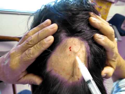 what are the side effects of cortisone shots for alopecia