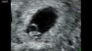 Echographie -- L'Embryon De 5 A 9 Semaines