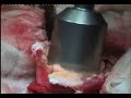 Hip Resurfacing (Birmingham ) Surgery- Vijay C Bose_Part 3