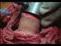 Hip Resurfacing (Birmingham ) Surgery- Vijay C Bose_Part 3