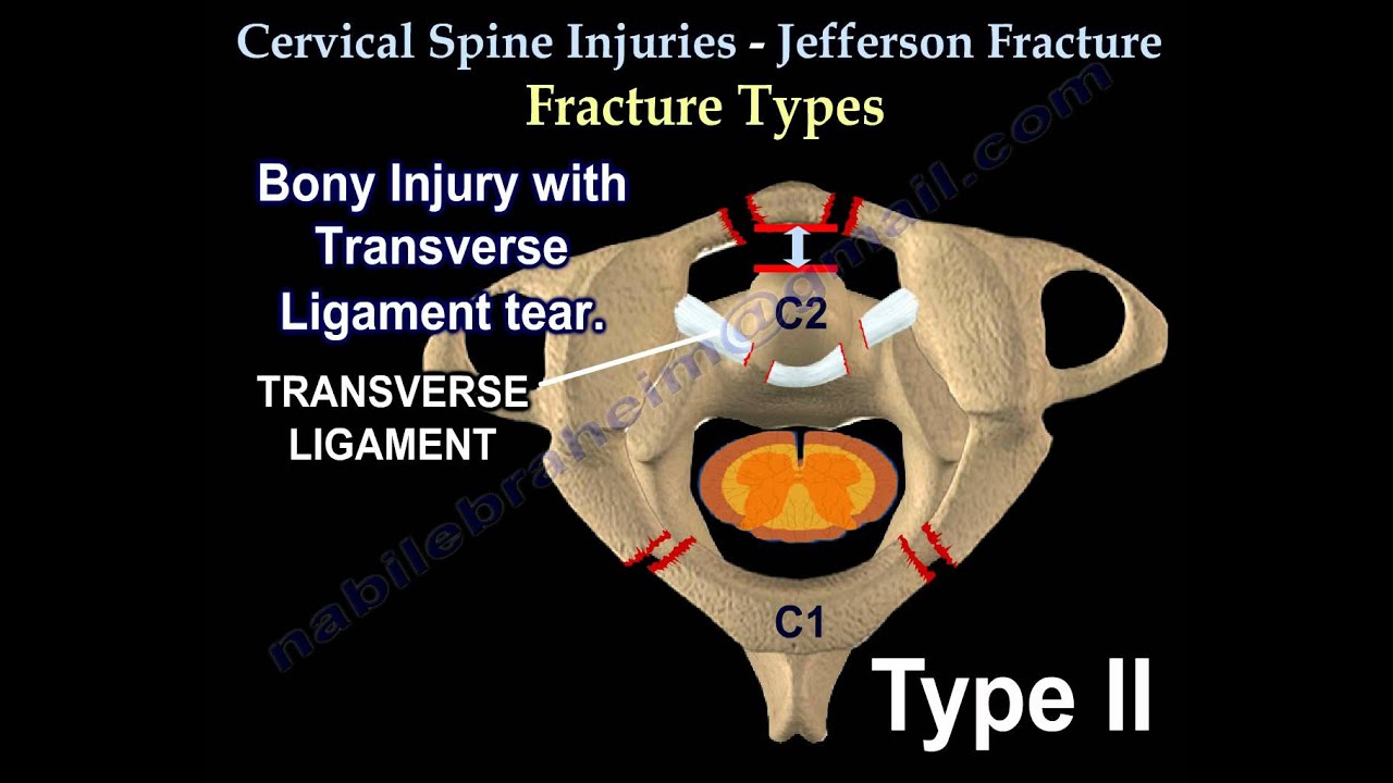 Cervical Spine Injuries Jefferson Fracture - Everything You Need To