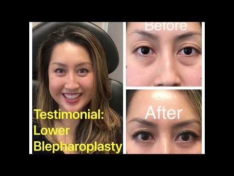 Asian lower blepharoplasty