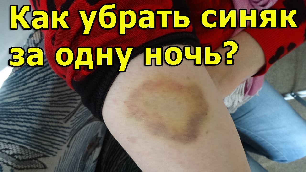 Чем избавится от синяка в домашних условиях Чем избавится от синяка в домашних условиях