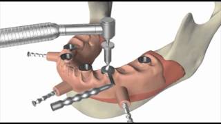 Implantes dentales con cirugía guiada