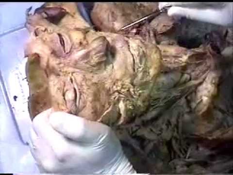 Gross anatomy - Cadaver face anatomy. (Audio is slightly out of sync